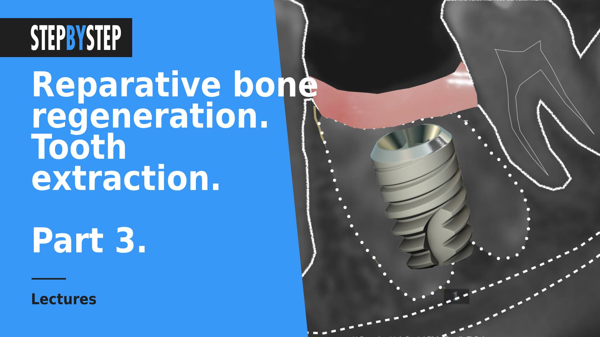 Reparative bone regeneration and rehabilitation on implants. Part 3. Extraction of teeth.
