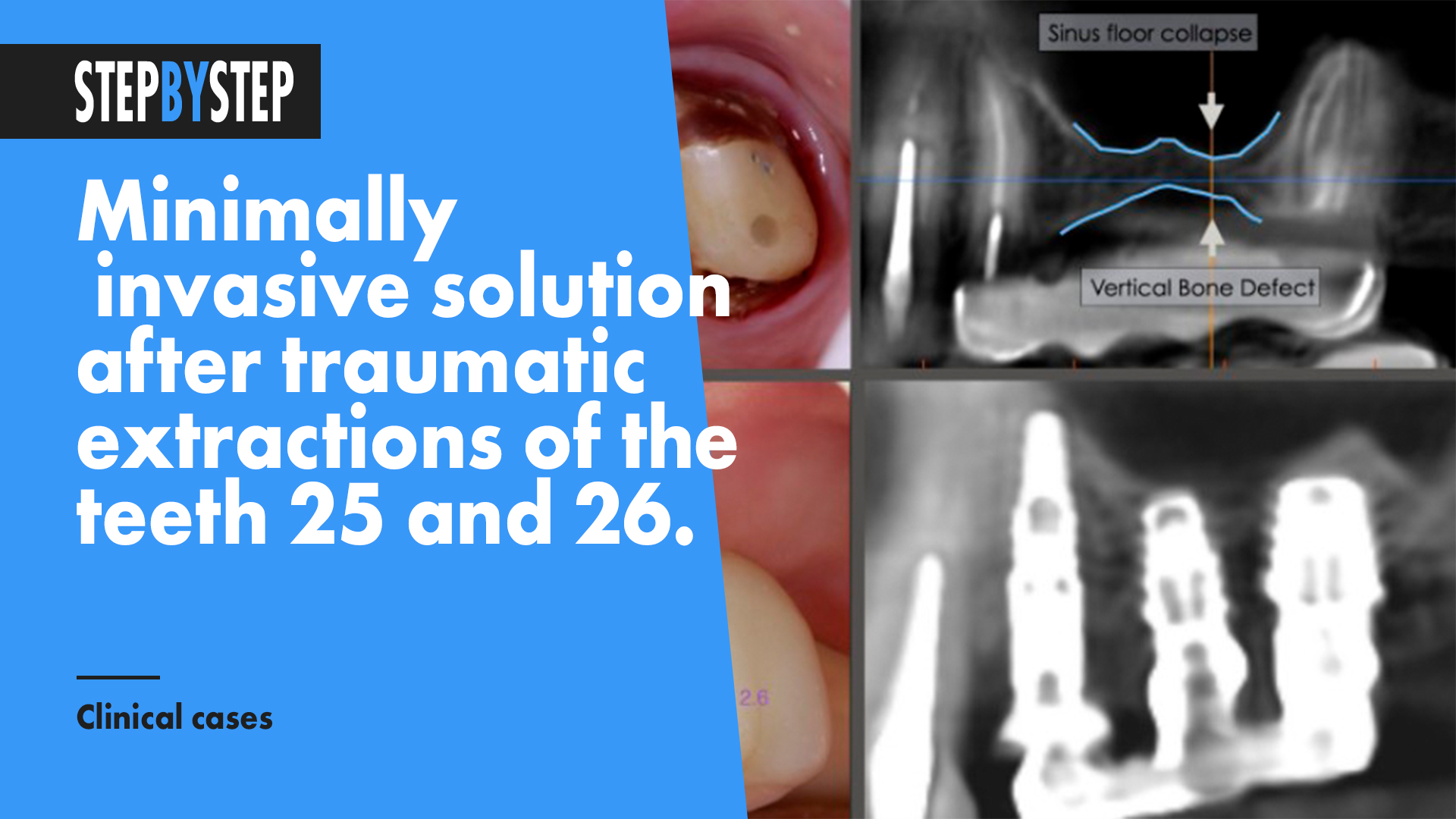 Minimally invasive solution after traumatic extractions of the  teeth 25 and 26.